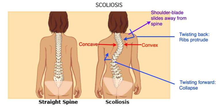 scoliosis2